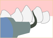 歯石・歯垢の除去