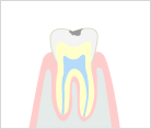 軽度のむし歯
