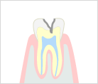 中度のむし歯