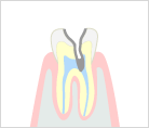 重度のむし歯