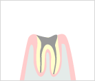 最重度のむし歯