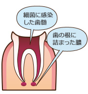 むし歯が歯髄まで感染した状態。