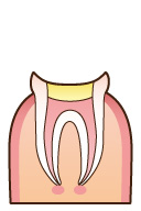 消毒が終わったら、充填剤をいれて密封します。