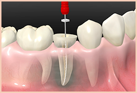 精密根管治療